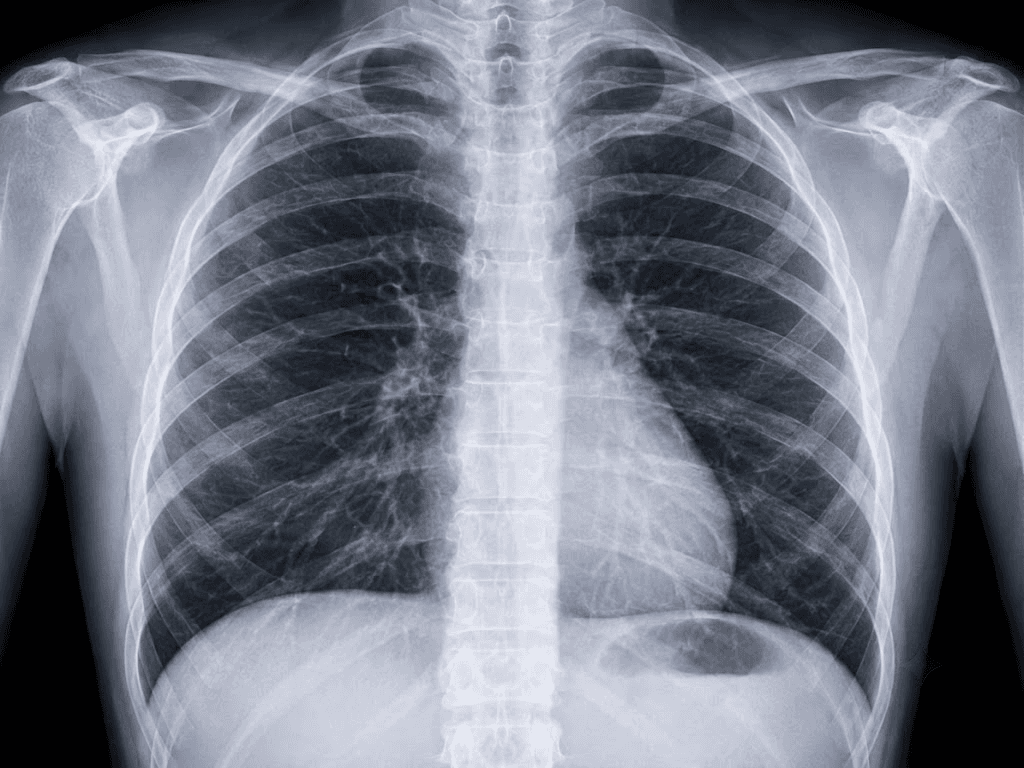 Chest X-Ray